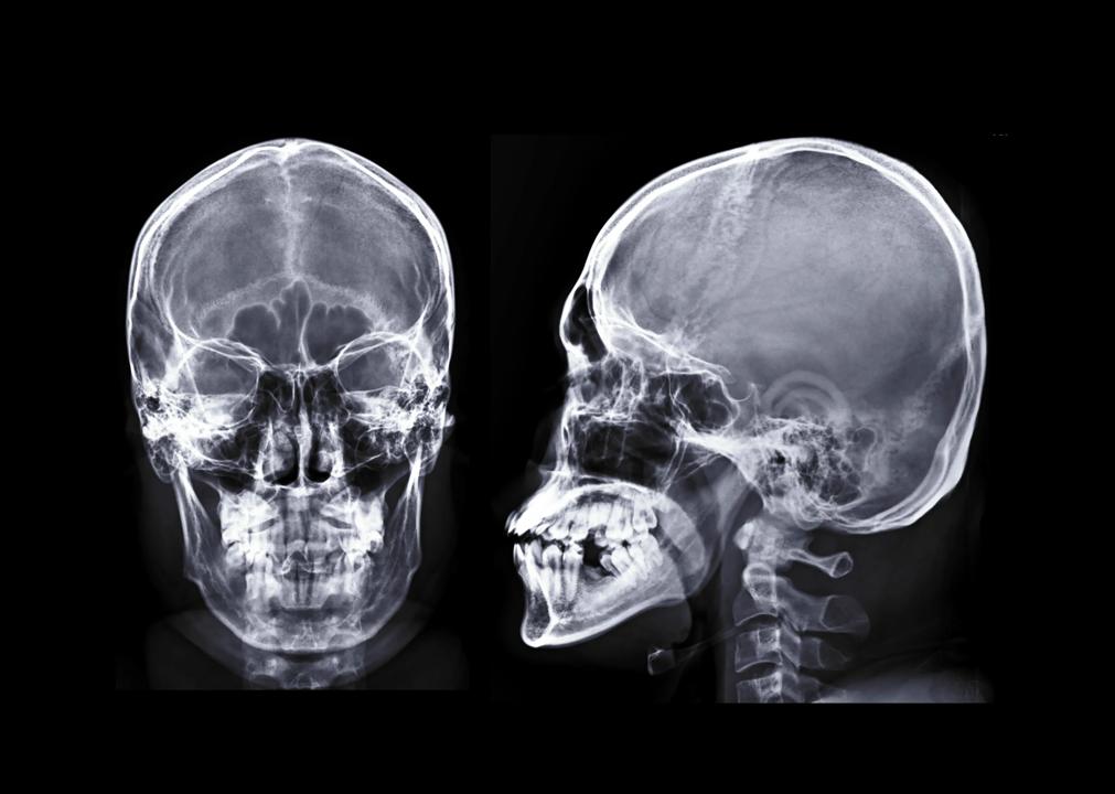 X-ray of human head
